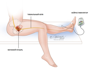 тибиальная нейромодуляция